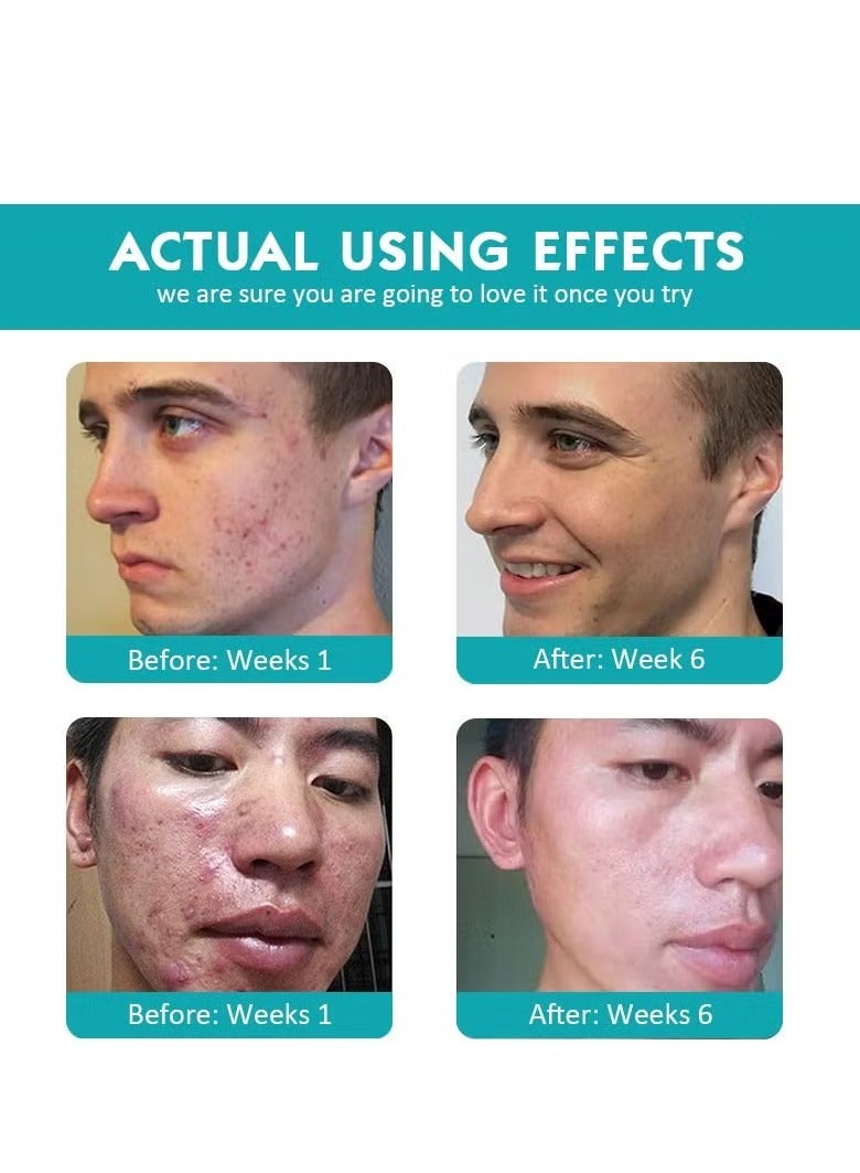 3 Step Acne Treatment 30 Day Complete Acne Skin Care Kit
