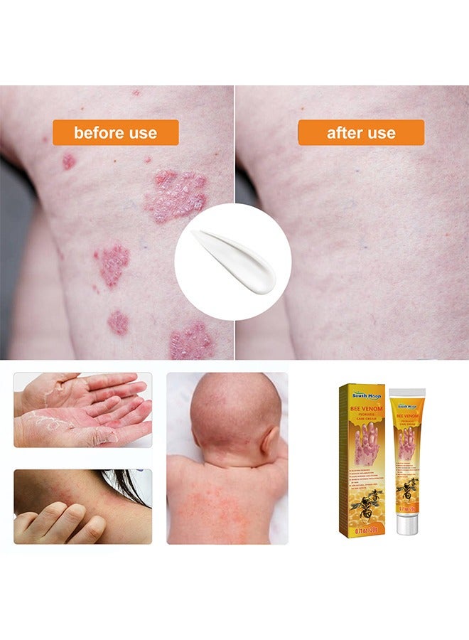 Bee Venom Psoriasis Cream - New Zealand Bee Venom Professional Psoriasis Cream For Itchy Skin Fast Relief Cream For Face And Body - Soothing And Moisturizing Psoriasis Cream 20 G