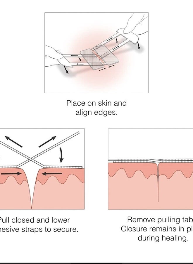 Complete Emergency Laceration Kit - Repair Wounds Without Stitches. FDA Cleared Skin Clean Cover Closure Device for 2 Individual Or Combine for 2 1/2 in. Length