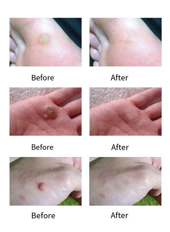 Wart Remover,Easy to Use Skin Tag Remover Safe and Effective Easy to use at Home Skin Tag Removal Serum 10ml