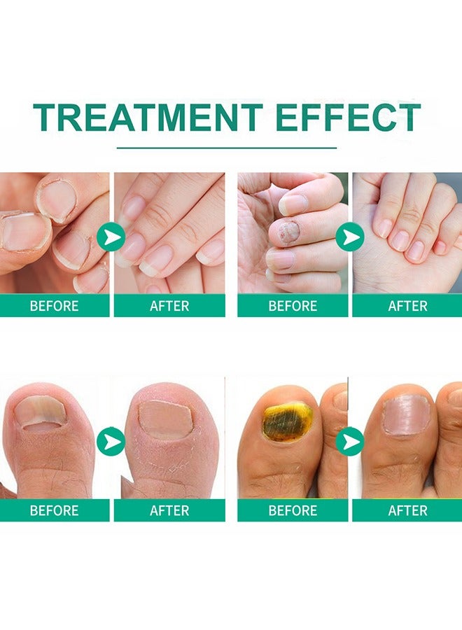 Nail Fungus Ointmen - Thickening, Brightening, and Repairing Solution for Damaged Nails on Hands and Feet