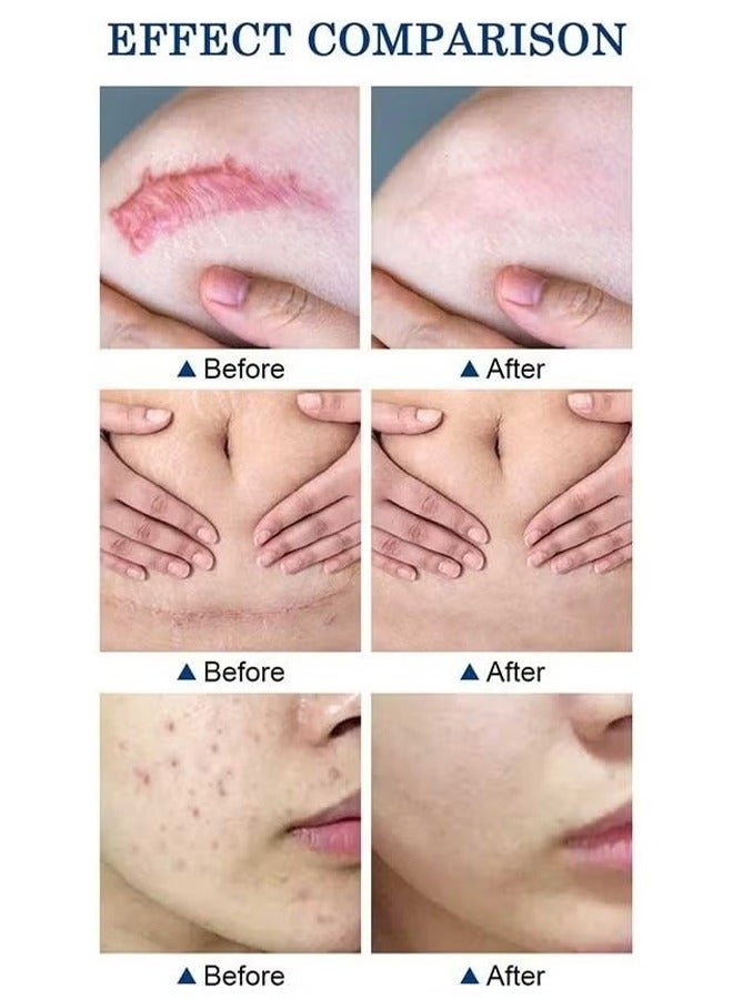Scar Removal Cream, Skin Repairing Cream Fade Scars/Stretch Marks/Acne Treatment, Improve Scar Skin, Deeply Moisturizes Skin