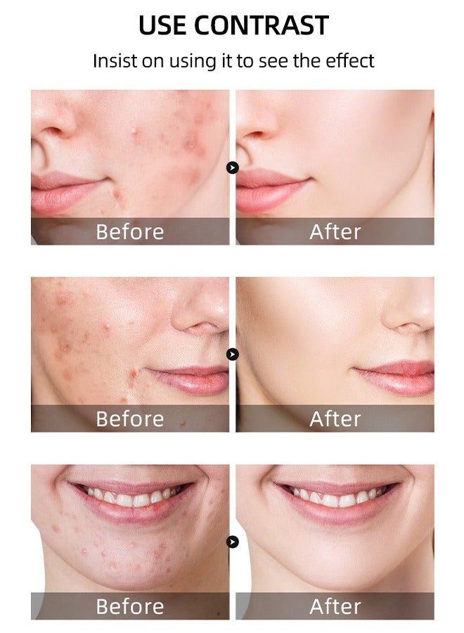 2 Pcs Salicylic Acid Remove Acne Gel, Rapid Action Acne Spot Treatment for Face Closure & Acne Dots, Premium Acne Scar Gel & Pimple Remover, 20g
