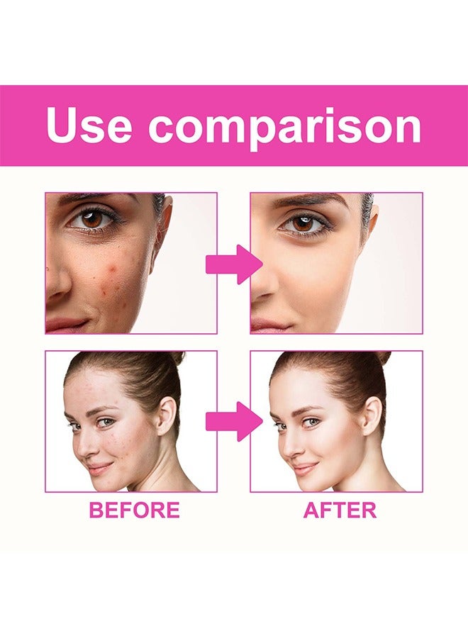 Pimple Acne Patches, Butterfly-shaped Acne Absorbing Cover Patch Hydrocolloid Spot Dots Stickers for Acne, Blemish, Pimples, Whiteheads Zit (160 Patches)