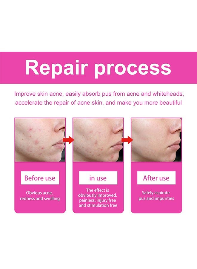 Pimple Acne Patches, Butterfly-shaped Acne Absorbing Cover Patch Hydrocolloid Spot Dots Stickers for Acne, Blemish, Pimples, Whiteheads Zit (160 Patches)