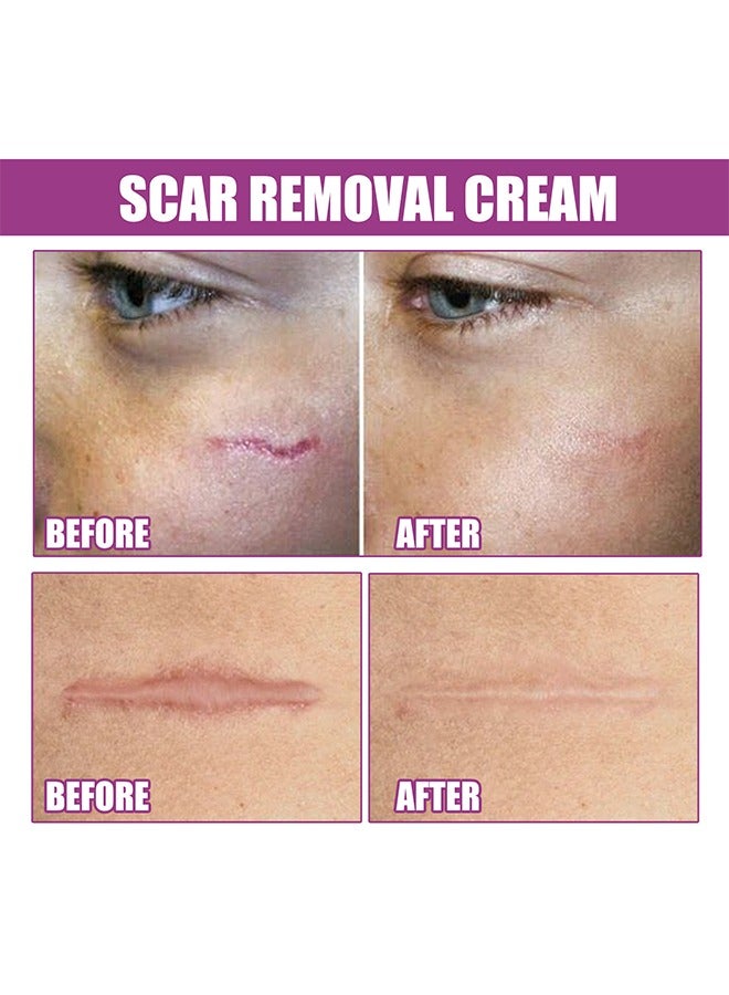 Scar Cream Fade Scald Scar Surgical Repair Cream, Lighten Scars Surgical Scars, Smooth Skin Repair,50 g
