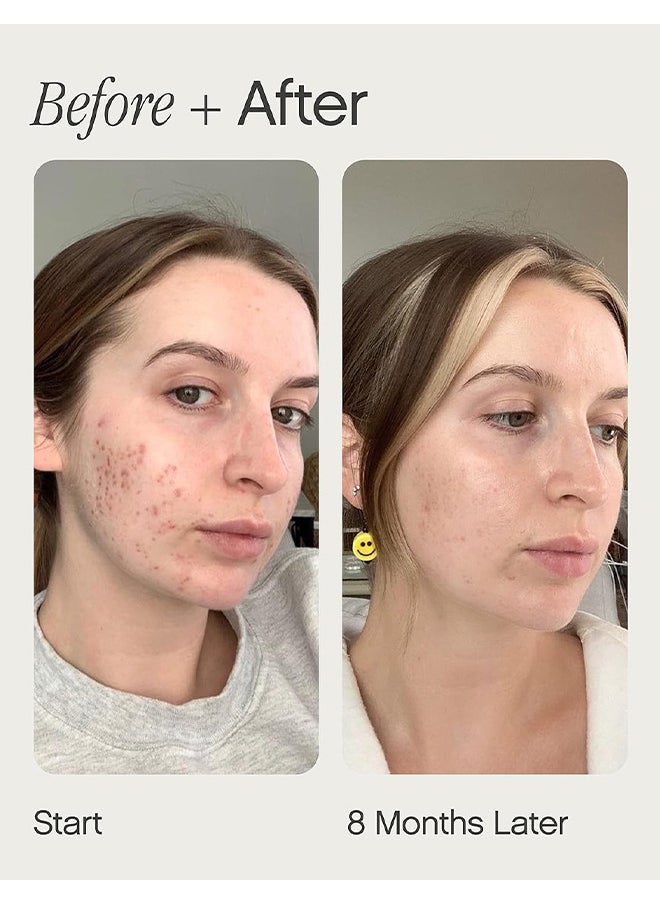 Brightening And Clearing Serum, Reduces Discoloration, Post-Blemish Marks, Scars And Spots, For Uneven Skin Tone, 15ML