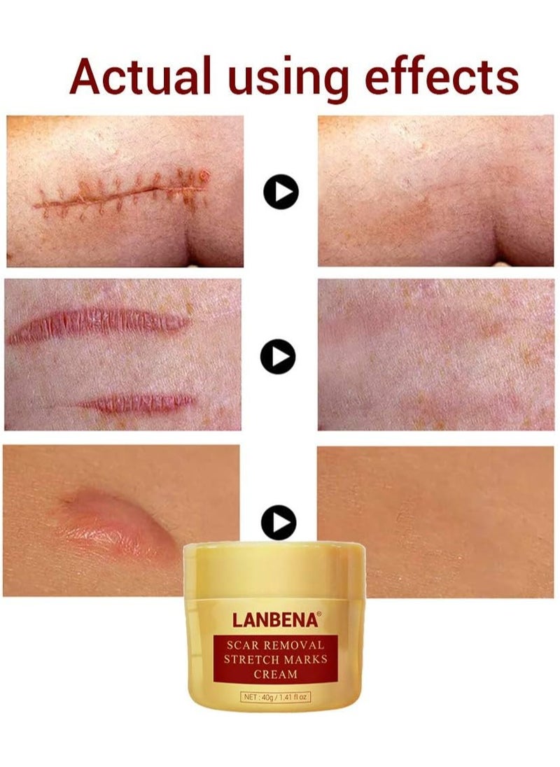 LANBENA Acne Scar Removal Cream Acne Repairing Scar Gel for Surgical Scars, Scars, Burns, Stretch Marks, Acne Spots, Fade Scar Melanin Acne Marks Pock Skin Care, Herbal Scar Cream Face Skin Repair