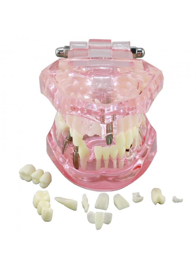 Dentalmall Teeth Model Teeth Typodonts Dental Implant Study Analysis Demonstration Teeth Model #2001 with Restoration Pink