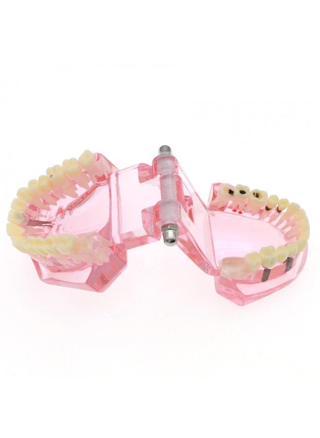 Dentalmall Teeth Model Teeth Typodonts Dental Implant Study Analysis Demonstration Teeth Model #2001 with Restoration Pink