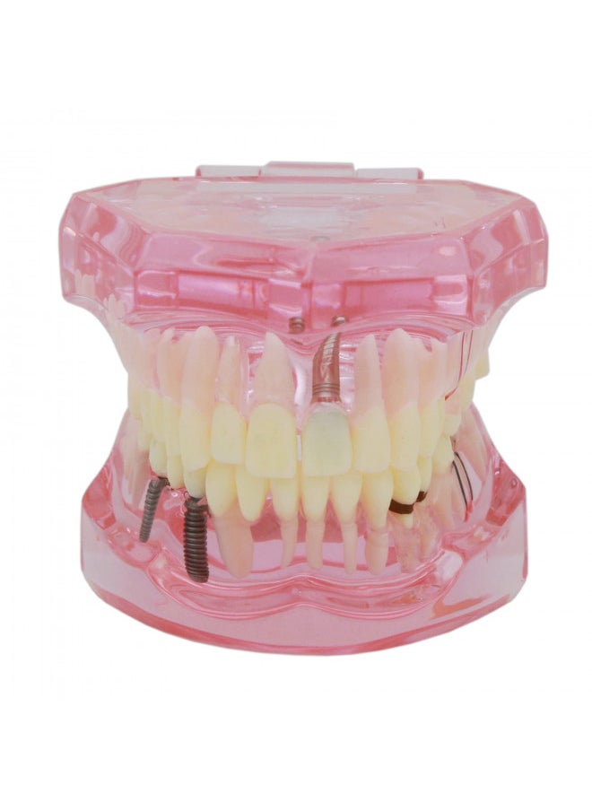 Dentalmall Teeth Model Teeth Typodonts Dental Implant Study Analysis Demonstration Teeth Model #2001 with Restoration Pink