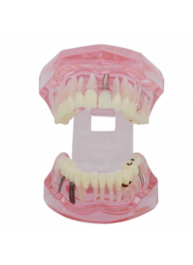 Dentalmall Teeth Model Teeth Typodonts Dental Implant Study Analysis Demonstration Teeth Model #2001 with Restoration Pink