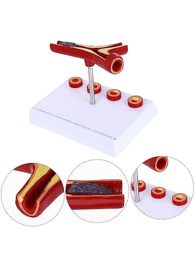 Atherosclerosis Medical Model Vessel Model Cardiovascular Model Medical Teaching Supplies