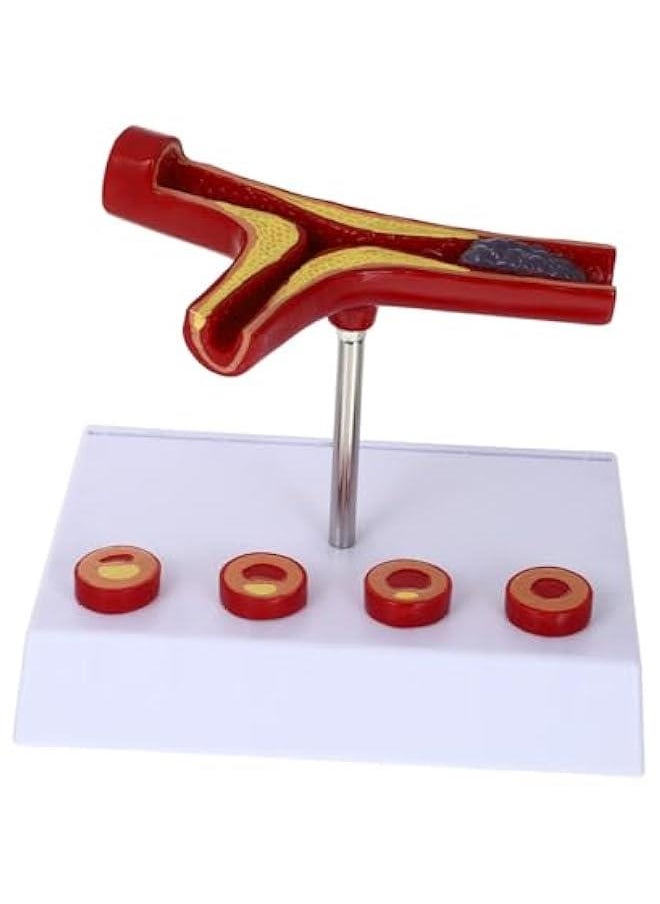 Atherosclerosis Medical Model Vessel Model Cardiovascular Model Medical Teaching Supplies