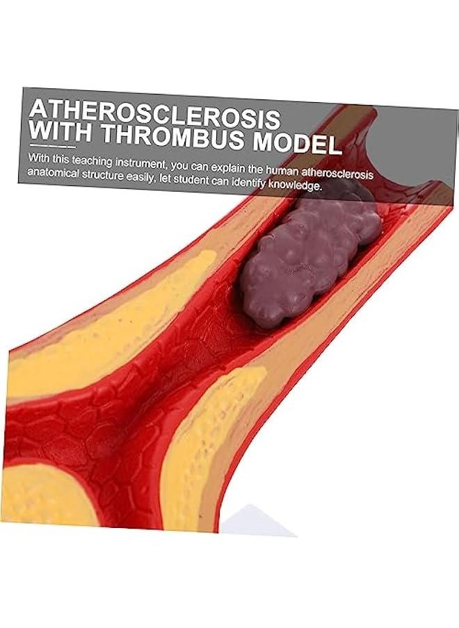 Atherosclerosis Medical Model Vessel Model Cardiovascular Model Medical Teaching Supplies