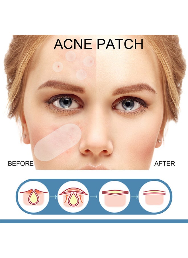 Acne Pimple Patches, 5 Sizes 80 Patches For Large Zit Breakouts, Acne Patches For Face, Chin Or Body, Acne Spot Treatment With Tea Tree And Calendula Oil, Hydrocolloid Bandages For Acne Skin