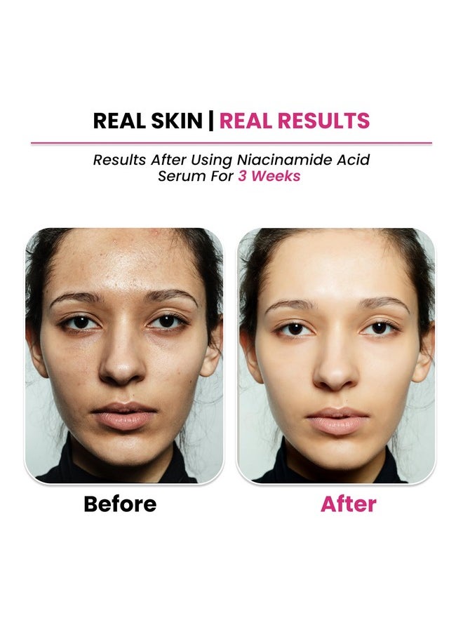 10% Niacinamide Face Serum + 1% Zinc Pca For Clear Glowing Skin | Reduction Of Acne | Men & Women, 30Ml