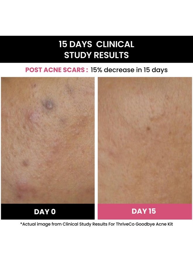 Goodbye Acne™ Face Serum For Pimples | Reduces Acne-Causing Bacteria & Sebum Production | Oil-Free Anti-Acne Serum With Diacnemide| Men & Women, 30Ml