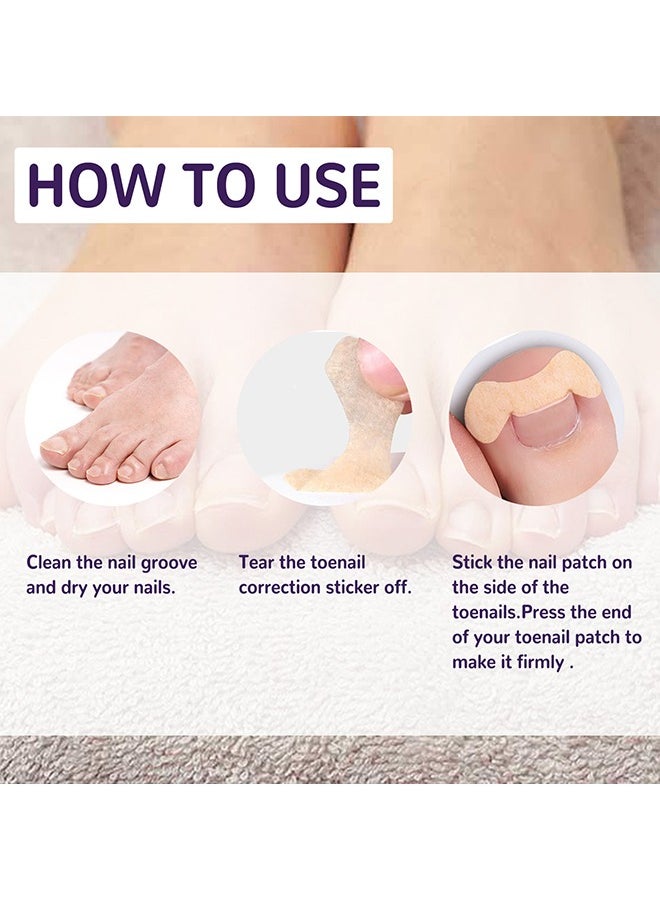 Ingrown Toenail Corrector Patch,Ingrown Toenail Corrector Strips, Toenail Corrector Patch,Self-Adhesive Elastic Toenail Correction Stickers Tool,Relieves Ingrown Toenail Groove Pain(50Pcs)