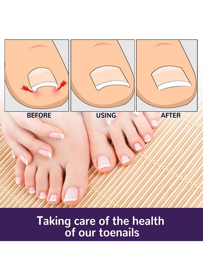 Ingrown Toenail Corrector Patch,Ingrown Toenail Corrector Strips, Toenail Corrector Patch,Self-Adhesive Elastic Toenail Correction Stickers Tool,Relieves Ingrown Toenail Groove Pain(50Pcs)