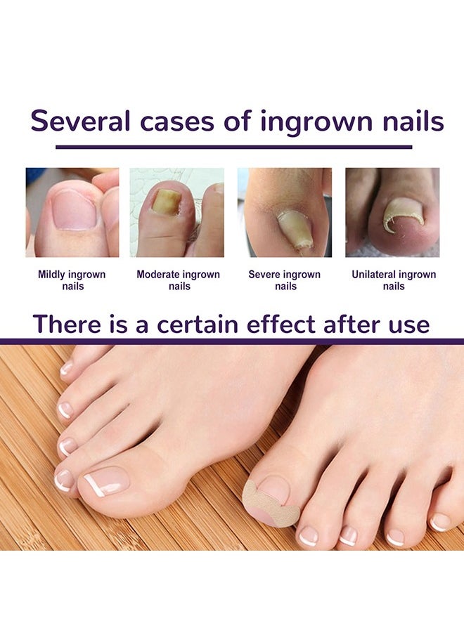 Ingrown Toenail Corrector Patch,Ingrown Toenail Corrector Strips, Toenail Corrector Patch,Self-Adhesive Elastic Toenail Correction Stickers Tool,Relieves Ingrown Toenail Groove Pain(50Pcs)