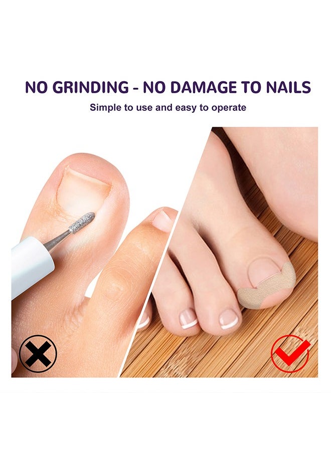 Ingrown Toenail Corrector Patch,Ingrown Toenail Corrector Strips, Toenail Corrector Patch,Self-Adhesive Elastic Toenail Correction Stickers Tool,Relieves Ingrown Toenail Groove Pain(50Pcs)