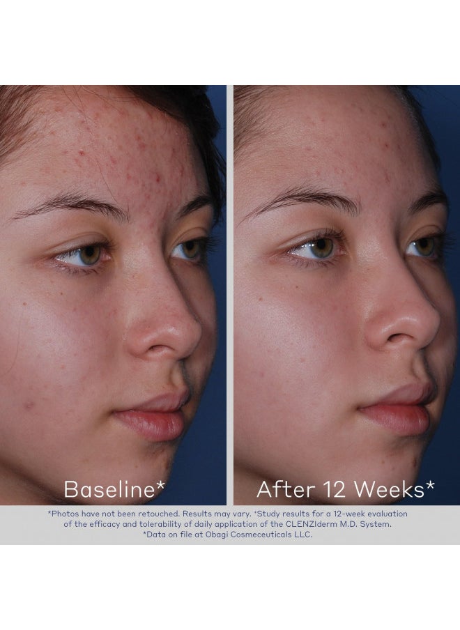 Obagi Clenziderm M.D. Pore Therapy Exfoliating Bha Toner   Unclogs Pores With 2% Salicylic Acid Acne Treatment 5 Oz