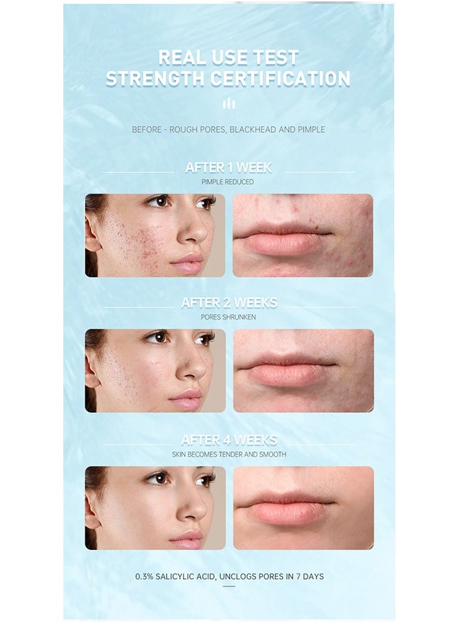Salicylic Acid Acne Treatment Cream, Acne Treatment Prevent Breakouts, Face Cream Whitening Facial Treatment Hyaluronic Acid Black Dots Remove Skin Care Beauty Health, Hydrating and Repairing Sensitive Skin Moisturizing Base Serum 15ml