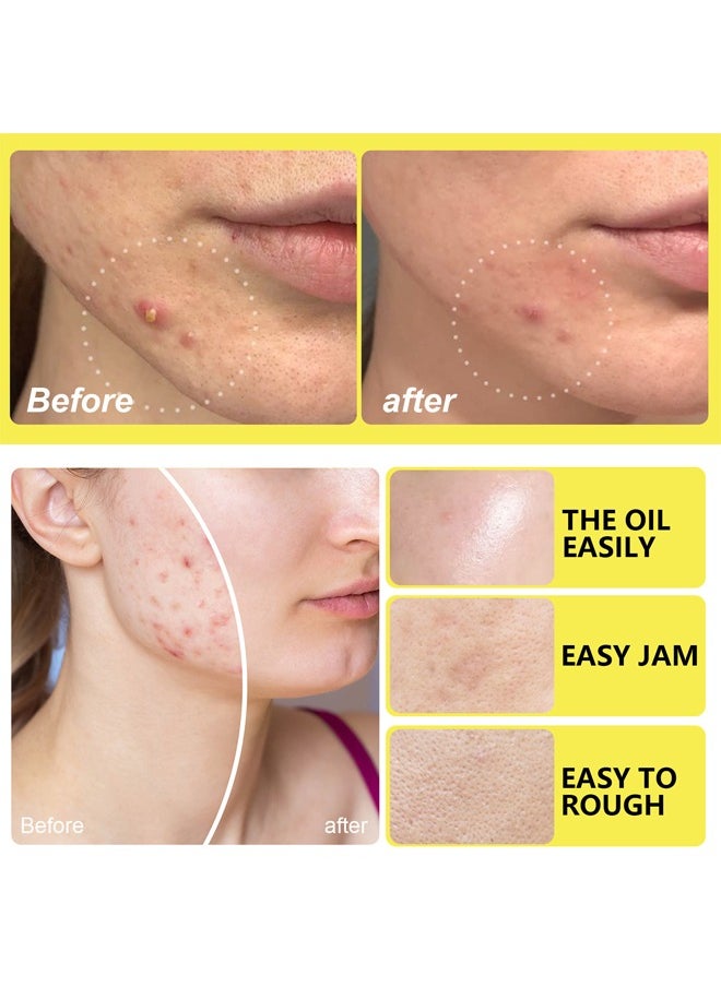 Hydrocolloid Acne Patches- with Tea Tree Oil Pimple Patches for Face Zit Patch and Pimple Stickers Hydrocolloid Acne Dots for Healing Acne with Zit Patches 10 Patches