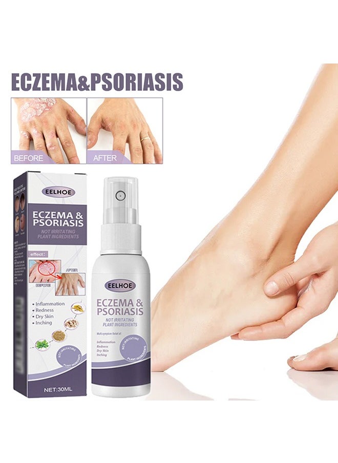 Eczema and Psoriasis Non-Steroidal 100% Natural Relief，Atomizing Spray 30ml, Hand and Foot Moss Skin Repair, Relieve Itching, Skin care and Jiejia spray, Antibacterialnot Irritating Safety