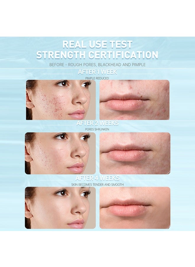 Salicylic Acid Acne Treatment Cream， Whitening Facial Treatment Hyaluronic Acid Black Dots Remove Skin Care Beauty Health