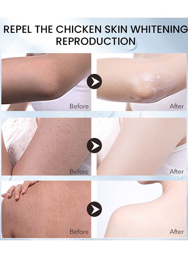 Keratosis Pilaris Repair Cream,Vitamin E cream, urea to remove dead skin cells 30g