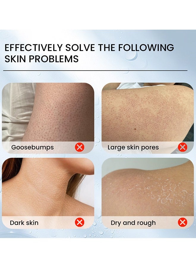Keratosis Pilaris Repair Cream,Vitamin E cream, urea to remove dead skin cells 30g