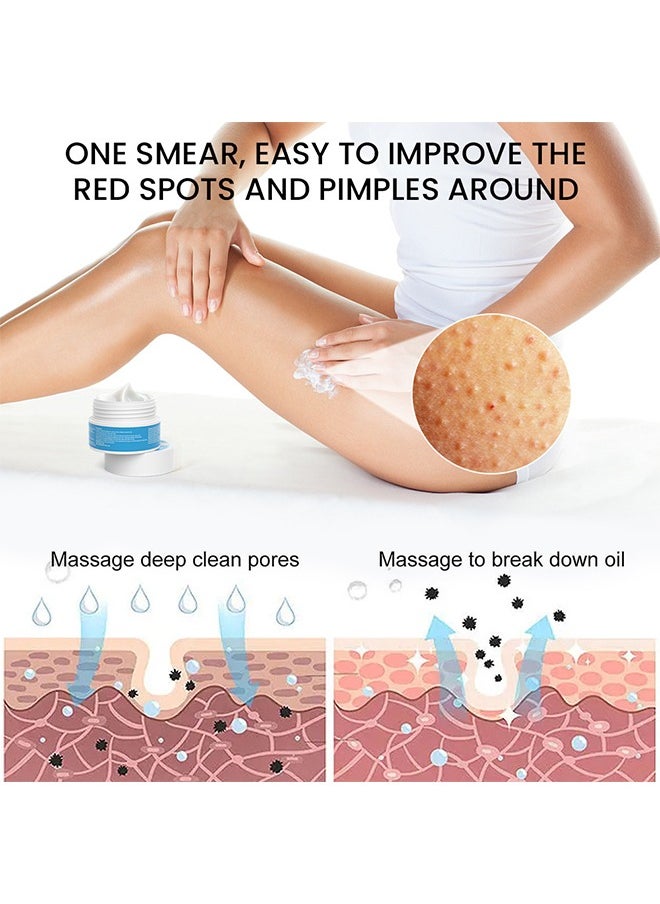 Keratosis Pilaris Repair Cream,Vitamin E cream, urea to remove dead skin cells 30g