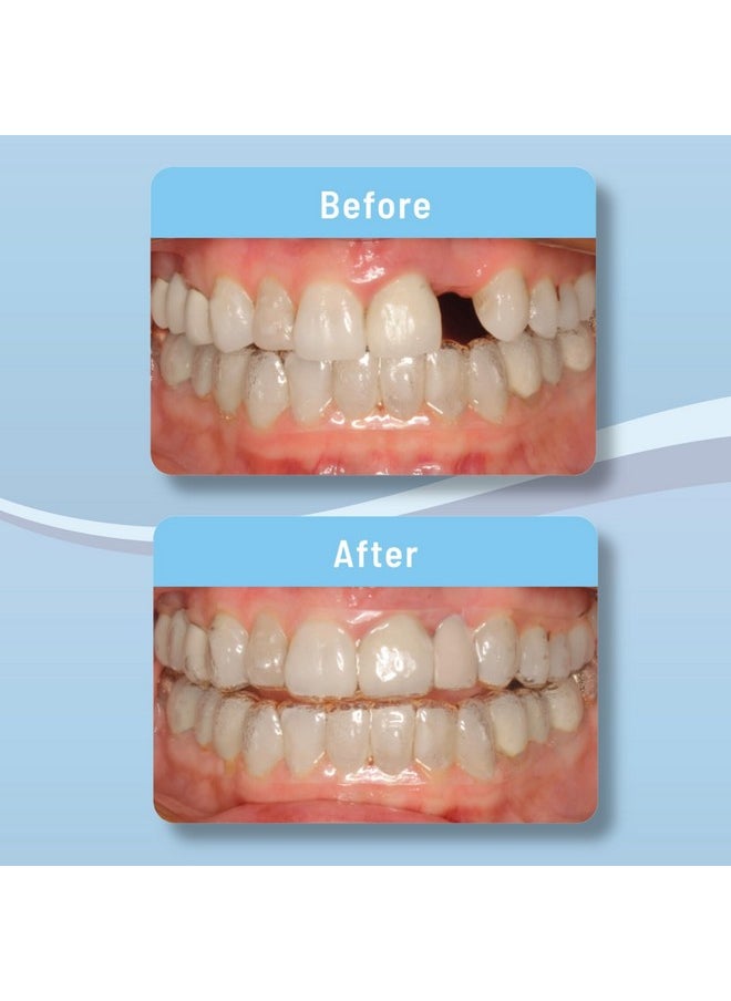 Aligner Pontics | Temporary Tooth Replacement For Aligner Trays And Retainers During Orthodontic Treatment (16 Count)