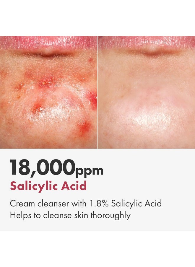 Salicylic Acid Foam Cleanser For Oily Skin, 18,000Ppm Salicylic Acid, Deep Pore Cleansing, Face Wash For Breakouts, Exfoliating Cleanser, Korean Skin Care, 100Ml, 3.38 Fl. Oz.