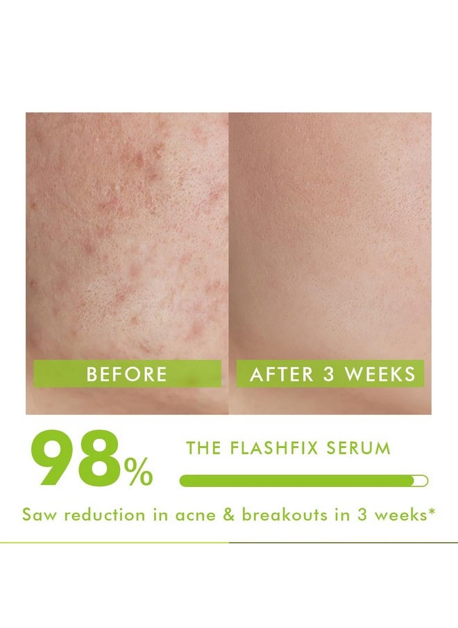 2% Salicylic Acid Serum | 30Ml | Face Serum For Acne, Blackheads & Opne Pores, Reduce Excess Oil & Bumpy Texture, Bha Based Exfoliant For Acne, Face Serum For Men & Women - Flashfix