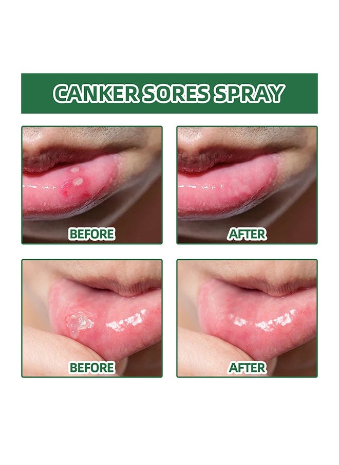 Canker Sore Treatment Spray ，Herbal Ulcer Treatment,Natural Mouth Sore Relief for Daily Oral Care, Mouth Spray,Treat Mouth Ulcer,Effective Mouth Sore Treatment-20ml