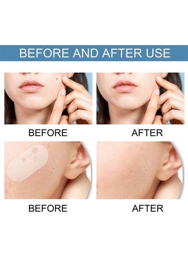 Acne Patch - 5 Sizes Of Patch Healing Acne And Pustule Can Be Used Day And Night , Acne patch can be made up IOnvisible Acne-Clearing Anti-acne-Closing Acne Waterproof Concealer Hydrocolloidal Acne Patch 80 Patches