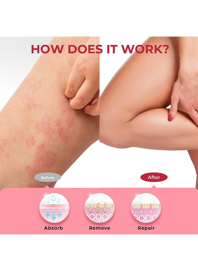 Eczema Relief Cream-Treatment Psoriasis Eczema Cream Antibacterial Antipruritic Dermatitis Herbal Ointment Anti-Itch Medical Plaster