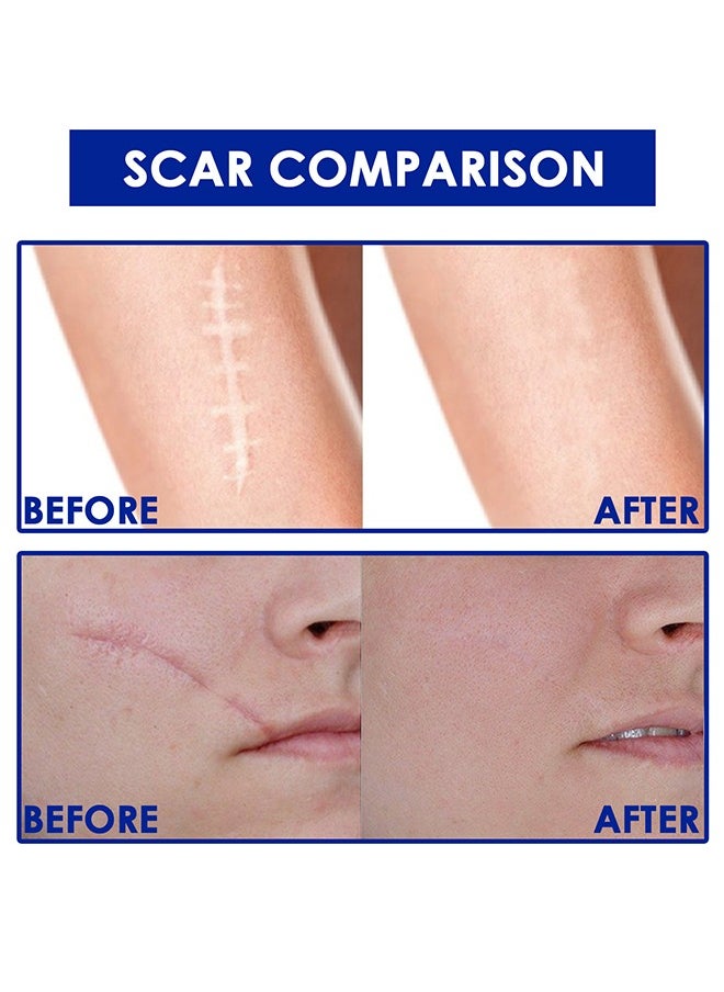 Advanced Scar Formula,Scar Repairing Gel,Wound-protecting scar gel burn wound caesarean section scar skin repair gel 15g