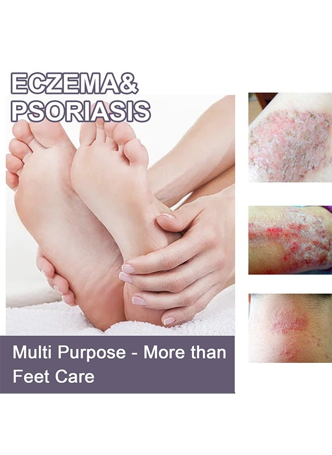 Eczema & Psoriasis - Eczema & Psoriasis Atomizing Spray, Hand and Foot Moss Skin Repair, Relieve Itching, Skin care and Jiejia spray, Antibacterialnot Irritating Safety 30ML