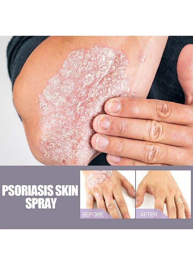 Eczema & Psoriasis - Eczema & Psoriasis Atomizing Spray, Hand and Foot Moss Skin Repair, Relieve Itching, Skin care and Jiejia spray, Antibacterialnot Irritating Safety 30ML