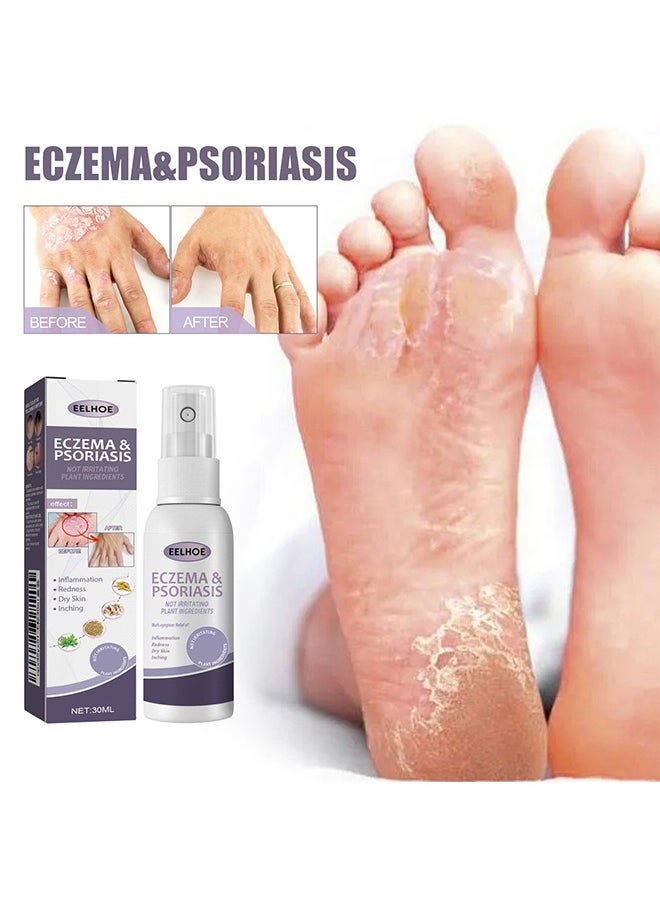 Eczema & Psoriasis - Eczema & Psoriasis Atomizing Spray, Hand and Foot Moss Skin Repair, Relieve Itching, Skin care and Jiejia spray, Antibacterialnot Irritating Safety 30ML