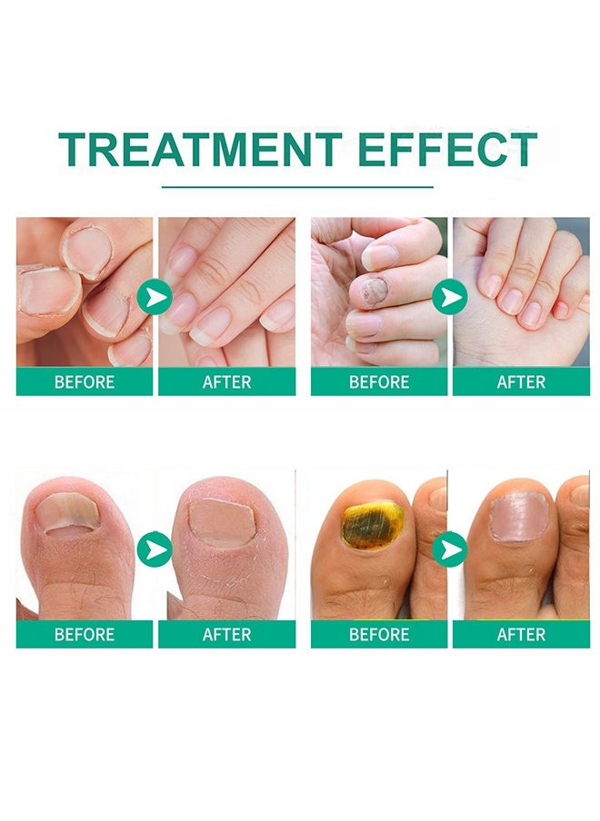 Nail Fungus Ointmen，Gray Nail Cream - Thickening, Brightening, and Repairing Solution for Damaged Nails on Hands and Feet. -20g