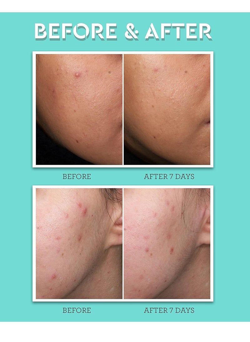 Bliss Clear Genius Acne Spot Treatment – Maximum Strength 2% Salicylic Acid Shrinks Blemishes – Clean, Vegan, Cruelty-Free, 0.5 Fl Oz