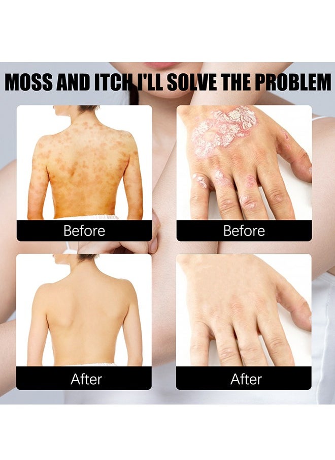 Eczema & Psoriasis Non-Steroidal100% Natural Relief，Dermatitis And Eczema Pruritus Psoriasis Spray, Say Goodbye To Scaly Skin, Eczema Relief Spray, Stops Burning And Itching 30ML