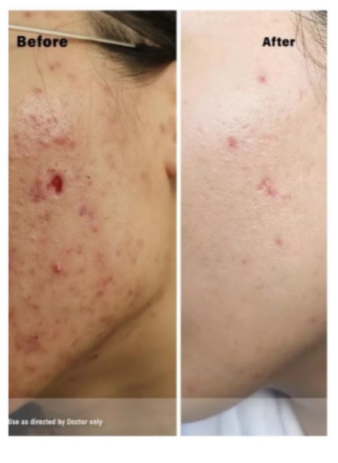 Skin Care Set for the Optimal and Ultimate Treatment for Acne and Skin Problems(Acretin 0.05% Acne Cream 30 gm + Hi Quin Pro Whitening Exfoliating Acne Treatment 4% Cream 30 gm + Acretin 0.025% Cream 30 gm)