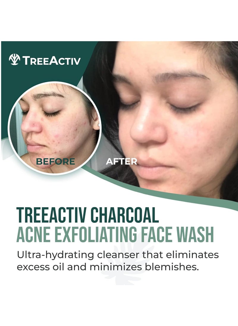TreeActiv Acne Charcoal Face Wash 3.4 oz, Exfoliating Daily Honey & Sulfur Face Wash - Sulfur Acne Treatment Cleanser Face Soap, Mens Face Wash, Deep Cleansing Moisturizing Face Wash for Women and Men