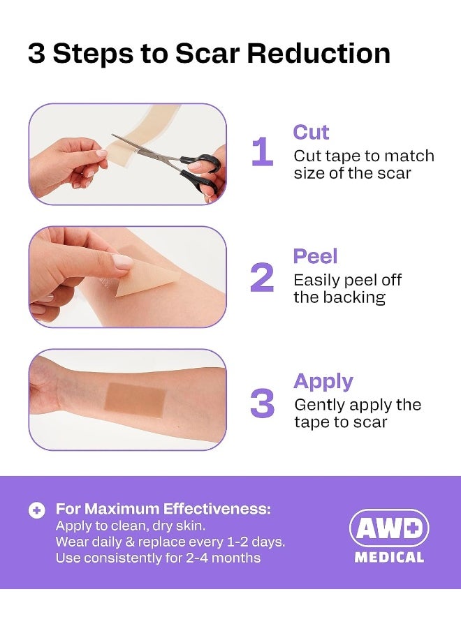 AWD Medical Soft Silicone Tape for Scars Removal with Silicone Gel Sheeting (1.6inx 120in)